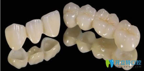 全瓷牙的價(jià)格一般多少錢(qián)