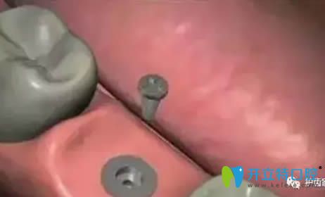 等待骨結(jié)合期 等待骨結(jié)合期