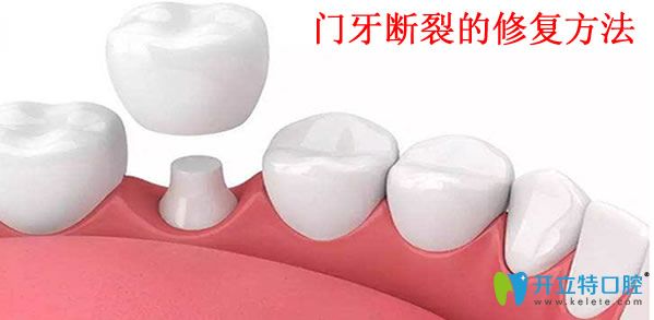 美麗雅口腔門牙斷裂的修復(fù)方法
