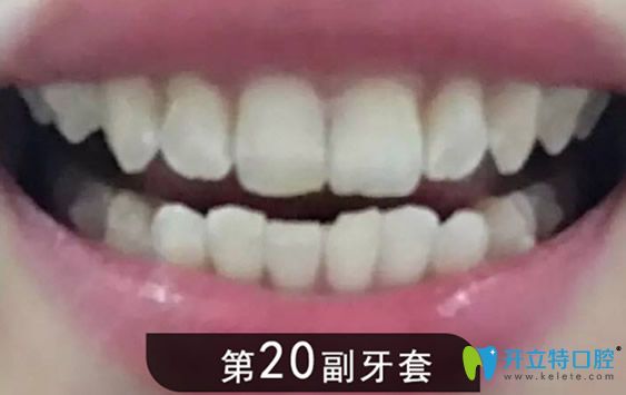 第20副牙套的矯正效果圖