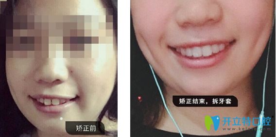 德仁口腔隱適美隱形矯正牙齒前后效果對(duì)比案例