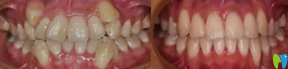 林敬波主任牙齒正畸代表案例