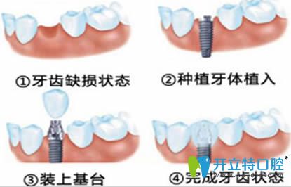 種植牙失敗有什么危害或副作用?做過全口種植牙的人來作答