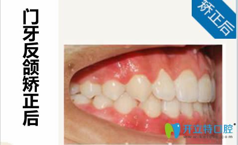 佩戴隱形牙套后的正畸療效