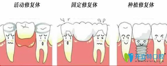 開立特口腔網(wǎng)牙齒修復(fù)體種類圖
