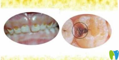 西安海濤口腔趙鑫醫(yī)生科普兒童齲齒的治療方法