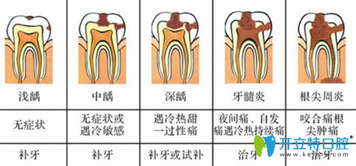 朋友說根管戴牙套牙會(huì)變黑,建議我根管后堅(jiān)決不做牙冠,對(duì)嗎