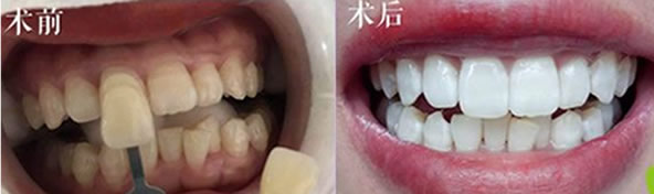 冷光美白對(duì)牙齒有危害嗎？關(guān)于為什么牙齒會(huì)變黃的小知識(shí)