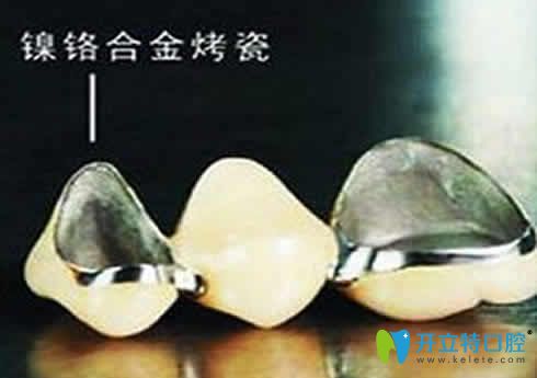網(wǎng)上說鎳鉻烤瓷牙會(huì)致癌是真的嗎？揭秘鎳鉻烤瓷牙的危害