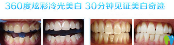 福州哪家牙科好？看貝臣齒科冷光美白案例來(lái)證明