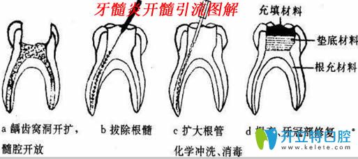 急性牙髓炎的處理方法圖解