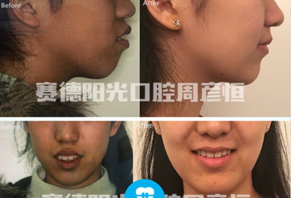 骨性齙牙怎么矯正帶牙套有用嗎 深圳賽德陽(yáng)光口腔正畸貴嗎