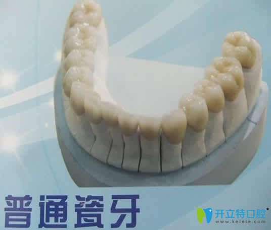 普通烤瓷牙多少錢一顆