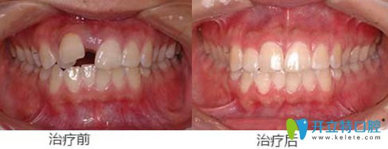 屬于天津美萊口腔的牙齒錯位、牙間縫矯正案例