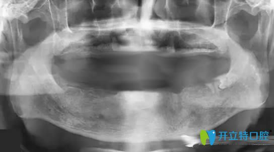 牙槽骨萎縮全景片