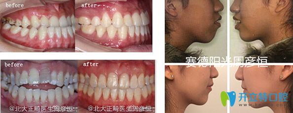 骨性齙牙正畸案例+牙齒咬合不齊矯正前后效果對(duì)比圖