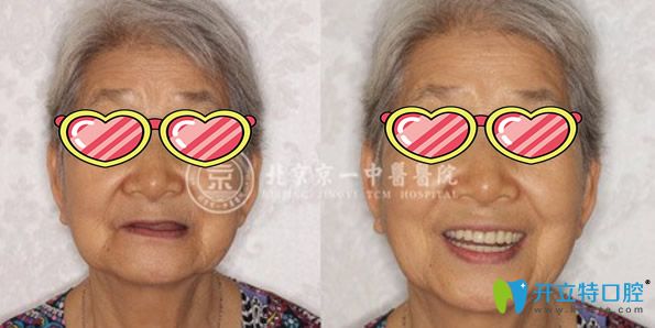 62歲楊奶奶在北京京一口腔種植全口牙后