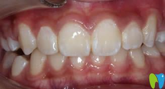 大連昭鶴口腔門診牙齒正畸后效果圖