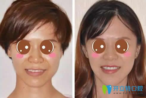 我在蘭州惠安齒科做牙齒矯正前后對比照片