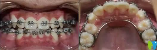 兒子在大連昭鶴口腔戴金屬托槽牙套的圖片