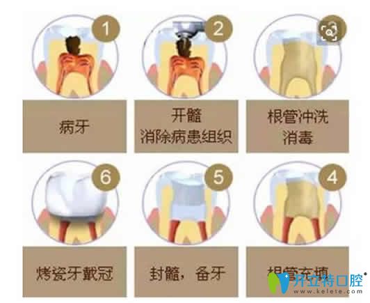 做了根管治療后牙疼怎么辦？根管填充后牙疼正常嗎？