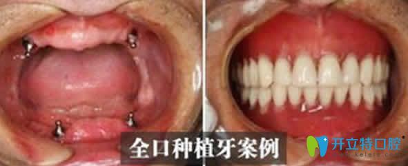 <!--<i data=20240703-sp></i>-->口腔全口種植牙案例對(duì)比圖
