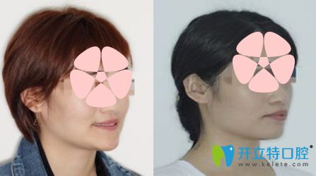 天津英瑞齒科怎么樣，地包天矯正案例來驗(yàn)證