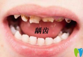 開立特兒童齲齒圖