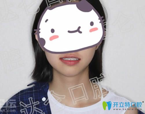 戴半隱形陶瓷牙套12個月后的矯正效果
