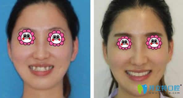 ?？趪趴谇换⒀莱C正前后對比圖