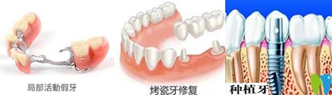 種植牙、活動(dòng)假牙和烤瓷牙哪個(gè)好？看完你就會(huì)明白哦