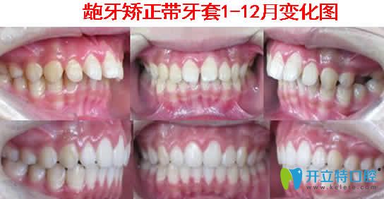 齙牙矯正帶牙套1到12個(gè)月變化圖