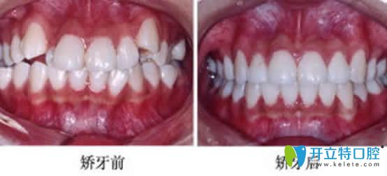牙齒擁擠矯正前后對(duì)比照片