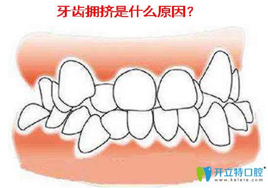 牙齒擁擠不齊怎么矯正 提供矯正方法及矯正前后對比照片