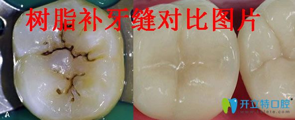 樹(shù)脂補(bǔ)牙縫對(duì)比圖片
