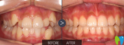 鄭州華領(lǐng)齒科矯正對比圖