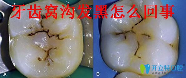 牙齒窩溝黑線怎樣能去除 光固化樹脂補牙縫及補牙價格分享