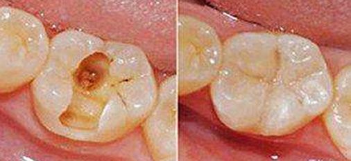 補(bǔ)牙齒用什么材料 分享光固化樹脂補(bǔ)牙壽命及注意事項(xiàng)