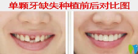 南昌輝煌口腔白彭院長(zhǎng)種植牙案例效果圖