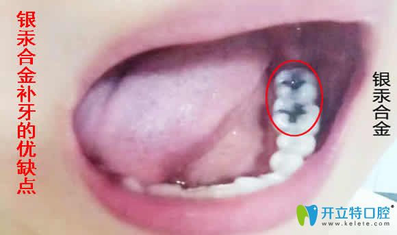 銀汞合金補(bǔ)牙的優(yōu)缺點(diǎn)