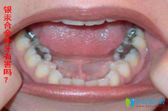 銀汞合金補(bǔ)牙有害嗎