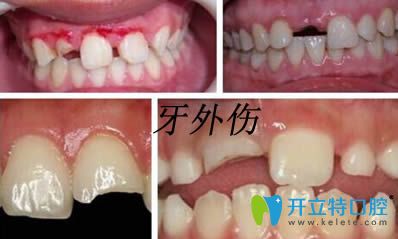 口腔知識:牙外傷處理原則以及兒童牙齒外傷脫位的應(yīng)急處理