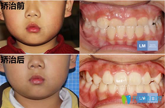 mrc矯正地包天案例及前后對比效果