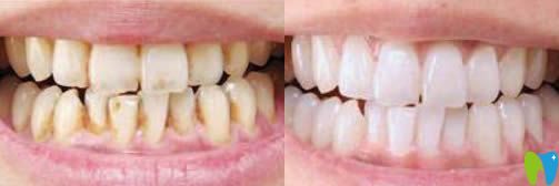 開(kāi)立特口腔牙齒冷光美白效果對(duì)比圖