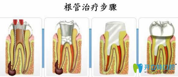 智麗媛醫(yī)生解答什么情況需要根管治療