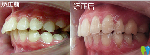 桂林瑾帆口腔好不好？真人牙齒矯正案例及術(shù)后反饋來(lái)驗(yàn)證