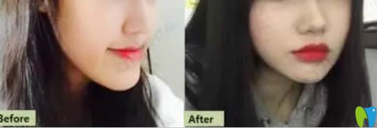 齙牙矯正案例效果及前后對(duì)比照