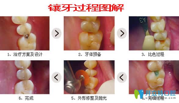 鑲牙過(guò)程圖解