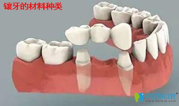 全面介紹鑲牙多少錢(qián)一顆及能用醫(yī)保嗎？