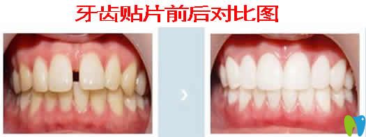 牙齒貼片前后對比圖